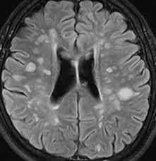 Das Ruckenmark Als Schlussel Zur Ms Diagnostik Healthcare In Europe Com