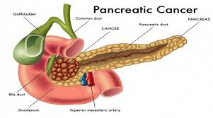 Jaundice occurs in about 50% of pancreatic cancer cases. Pancreatic Cancer