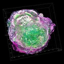 If there is redness in areas away from the scar, contact your physician. Chemotherapy Before Breast Cancer Surgery Might Fuel Metastasis