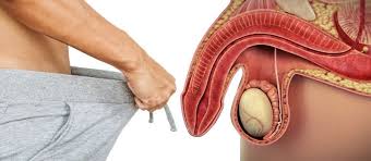Image result for Erectile Dysfunction