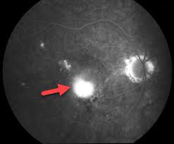 Histoplasmosis Louisville Ky Eye Surgery Florence