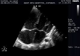 Image result for Endocardial Cushion Defect