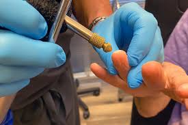 Image result for Cryotherapy