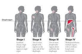 Munker r., hasenclever d., brosteanu o., hiller e., diehl v. Hodgkin Lymphoma Staging Leukemia And Lymphoma Society