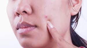 As you examine your skin for early signs of skin cancer on your face, you should be checking your whole … Can Skin Cancer Look Like A Pimple