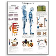 Osteoporosis Chart English Vr1121l 1001472 Posters