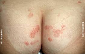 Cluster of vesicles due to hsv2. Buttock Boils Herpes And Fungal Infections Treatment Healthise Com