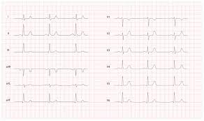 Sie kann akut oder chronisch verlaufen. Ecg Amboss