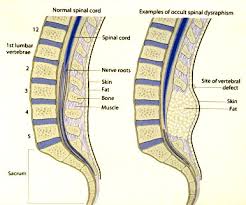 Image result for Spinal Dysraphism