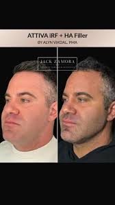 What is Attiva? , ATTIVA iRF is a non-surgical, non-invasive radiofrequency  treatment for the face and body that provides visible results with little  to no downtime. ATTIVA delivers radiofrequency ...