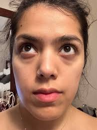 Dark circle and acne scar treatments