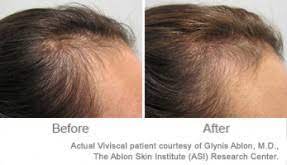 Additionally, vitamin c is vital for the absorption of iron. Top 3 Vitamins For Thicker Hair Growth Viviscal Healthy Hair Tips