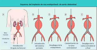 Il trattamento degli aneurismi dell'aorta toracica può essere effettuato mediante chi. Aneurismas De Aorta Centro Medico Teknon