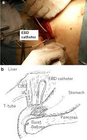 ◄ go back to general radiograhy page◄ go back to <a href=/ target=_self>wikiradiography</a> home page. Surgical Procedure For Unexpected Balloon Burst Complication During Endoscopic Balloon Dilatation In A Patient With Common Bile Duct Stones Surgical Case Reports Full Text