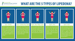 Women with lipedema frequently feel like they have two bodies, dr. Lipedema Symptoms Stages Treatment St Louis Liposuction Center