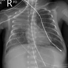 The chest cavity captivates different degrees of radiation creating different. Respiratory Distress Syndrome Radiology Reference Article Radiopaedia Org