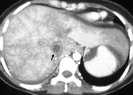 Diagnostic And Interventional Radiology For Budd Chiari Syndrome Radiographics