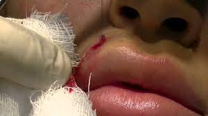 Beverly Hills Model Actress Lip Piercing Removal And Scar Removal Painless Procedure No Scar Youtube