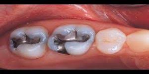 Diş diplerinde zaman zaman siyah lekeler görülebilir. Dislerin Siyaha Donusmesine Ne Sebep Olur Bilgiustam