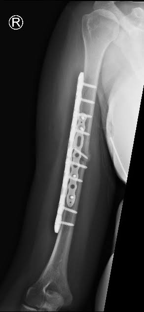 Humerus Shaft Fracture Treatment, Interlocking Nailing & Plate ORIF in Jamshedpur | Dr. Pritpal Singh Saini