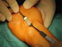Ganglion Der Hand Univ Prof Dr Gabler Sportambulatorium