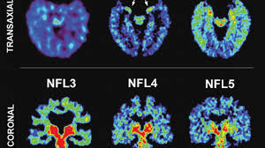 A brain lesion appears as a dark or light spot that does not look like normal brain tissues. Scan May Detect Signs Of Nfl Players Brain Disease