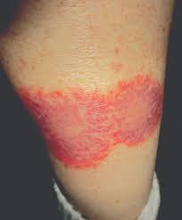 The disease is benign and has about 5 main. How To Recognize And Manage Granuloma Annulare