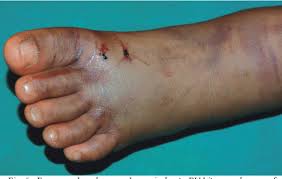 You may think it is another kind of bite or scratch. Snakebite Envenoming Fact Sheet Africa Health Organisation
