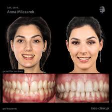 Pani Daria zgłosiła się do nas z powodu bólu w stawie skroniowo-żuchwowym.  U pacjentki rozpoznano tendencję do tyłozgryzu całkowitego, przechylone  siekacze górne, pogłębiony nagryz pionowy oraz nieprawidłowości zębowe. ✓W  pierwszym etapie pacjentka