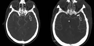 Intrakranielle Aneurysmen Uniklinik Tubingen Neurochirurgie