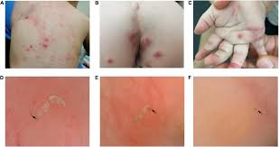 Image result for scabies on genitals