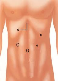 The left upper quadrant extends from the umbilical plane to the left ribcage. Locations Of Ports And Mini Laparotomy Wounds Right Upper Quadrant Or Download Scientific Diagram