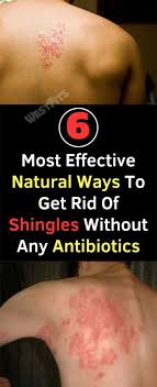 Pin By Mindy Crawford On Health Shingles Treatment Shingles Remedies Skin Care Remedies