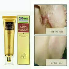 Cara membuat masker lidah buaya untuk menghilangkan bekas jerawat berlubang: Gel Penghilang Bopeng Bekas Jerawat Keloid Bekas Luka Bakar Bekas Luka Iris Shopee Indonesia