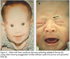 Neonate With Hypotonia And Subtle Anomalies Consultant360
