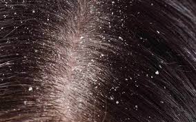 It may be best to use a sprayer to apply the liquid evenly to the scalp. How To Get Rid Of Dandruff Through Ayurveda Vedix