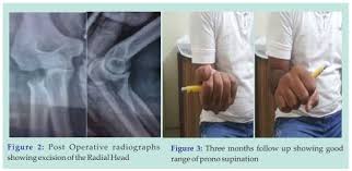 Image result for Radial Head Dislocation