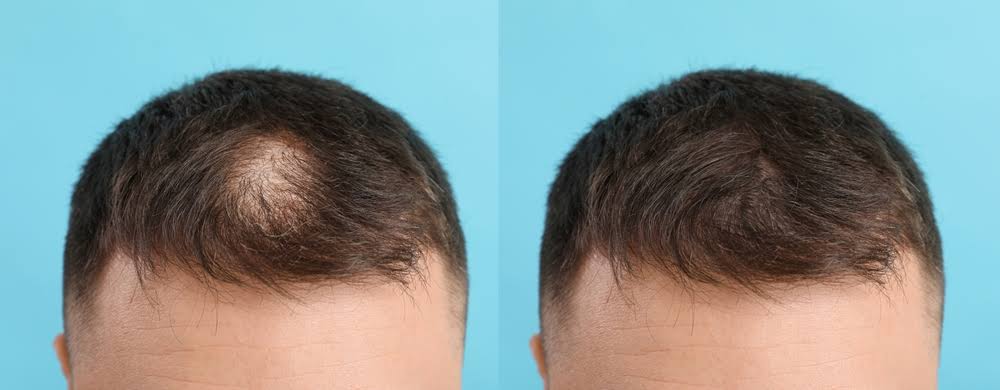 Alopecia Areata-patchy hair loss product image