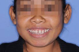 Relación de la caries dental y el índice de masa corporal en población  infantil