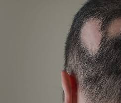 While rosacea may make some patients want to tear their proverbial hair out, a recent small study discovered a potential association between the disorder and a form of progressive hair loss in women. Alopecia Areata Treatment Uk Hair Loss Treatment London