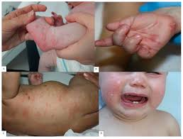 Image result for scabies human children