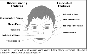 An epicanthic fold, epicanthal fold, or epicanthus is a skin fold of the upper eyelid (from the nose to the inner side of the eyebrow) covering the inner corner (medial canthus) of the eye. Table 1 1 From Genetic Susceptibility To Fetal Alcohol Syndrome In The Northern Cape Coloured Population Potential Roles Of Astrotactin And Reelin Semantic Scholar