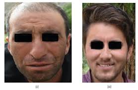 View of Morpho-facial variations in physical features of two tribal  populations of Kargil (Ladakh, India): A bio-anthropological investigation 