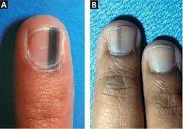 Odd changes in your nails can very likely be nothing to worry about! Evaluation Of Nail Lines Color And Shape Hold Clues Cleveland Clinic Journal Of Medicine