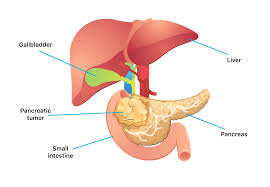 When signs and symptoms of pancreatic cancer occur, they include (these to not occur in pancreatitis): Pancreatic Cancer Symptoms Causes Types Stages And Treatment