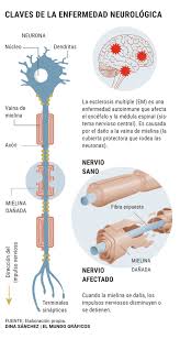 Infelizmente a esclerose múltipla não possui cura, assim, o seu tratamento consiste basicamente em controlar os sintomas da doença e limitar o desenvolvimento da doença no organismo do paciente. Controlar La Inflamacion Clave Para Evitar El Empeoramiento De La Esclerosis Multiple Salud