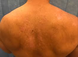 How is sle different from other forms of lupus? Why We Study Skin