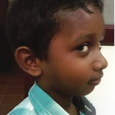 Pilomatricoma of the Pinna