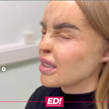 Katie Piper's discomfort clear as she shares video having prosthetic eye  fitted and admits: 'I've reached the end of the road' 💔 ⬇️