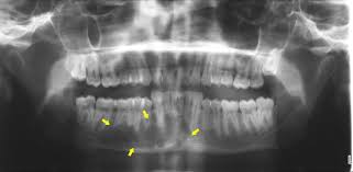 See mouth cancer pictures to learn what common mouth cancer sores on the tongue, gums, and cheek look like. First Mandibular Tumor Enucleation And Immediate Reconstruction Through An Intra Oral Approach At Nmc Experts In Medical Care